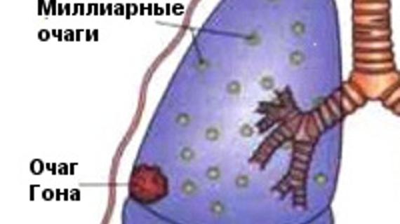 Гон легких. Очаг гона при туберкулезе.