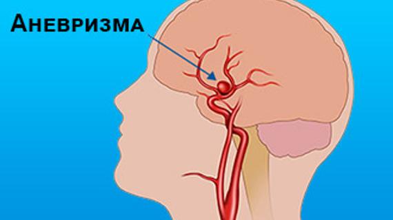 Аневризма сонной артерии шеи фото