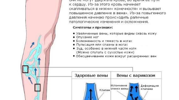 Варикоз корнилова схема