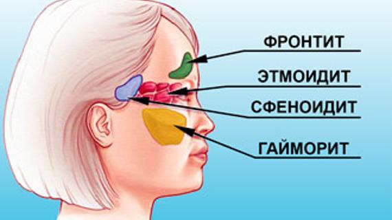 Схема лечения этмоидита